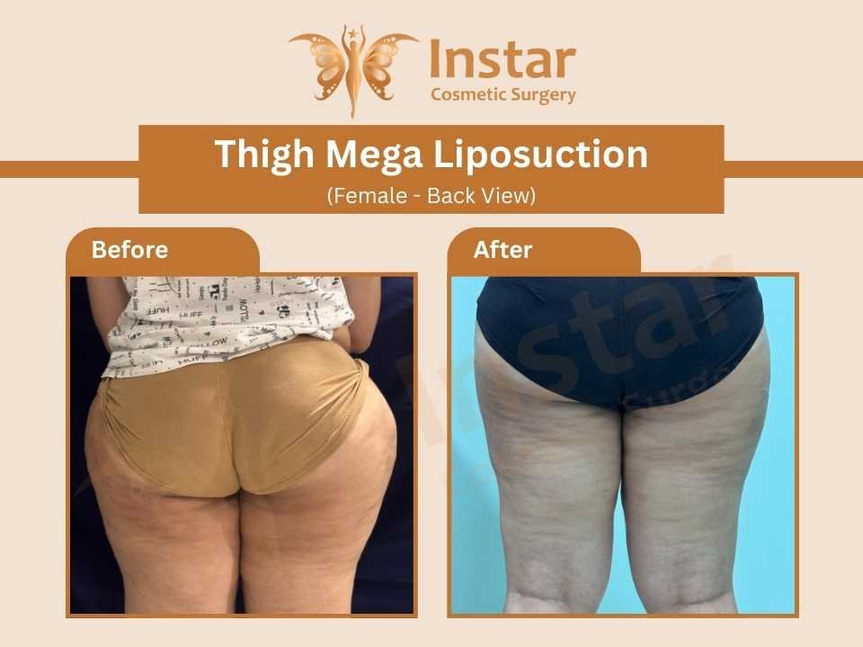 Thigh-Mega-Liposuction-female-oblique-view (2)
